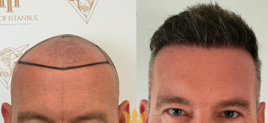 Fue Hair Transplant