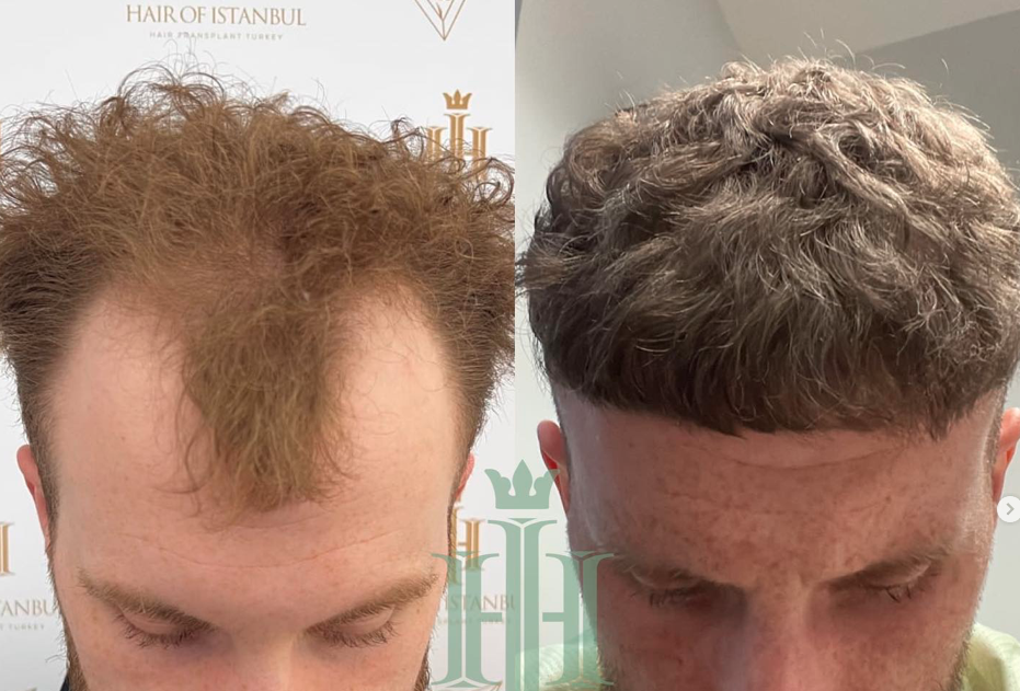 Hair Transplant Cost in Istanbul