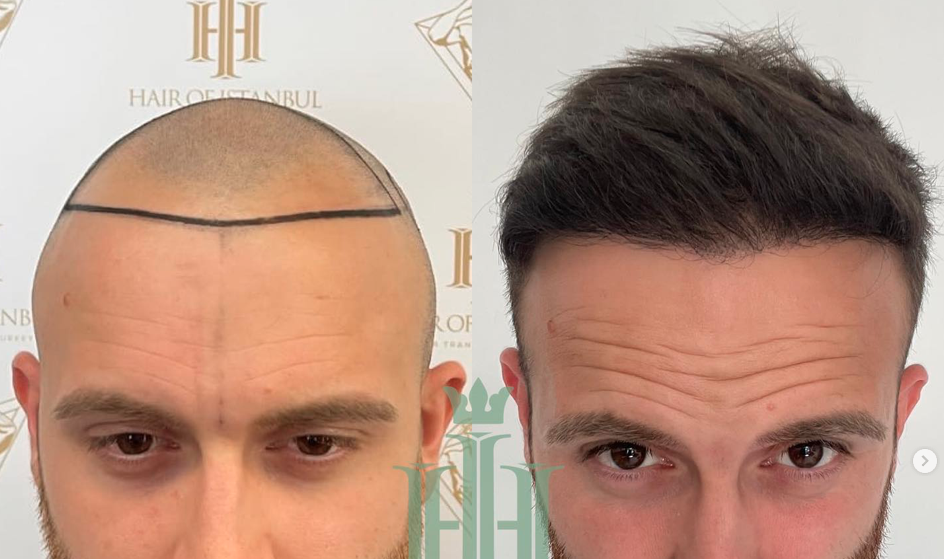 Fue Hair Transplant Result